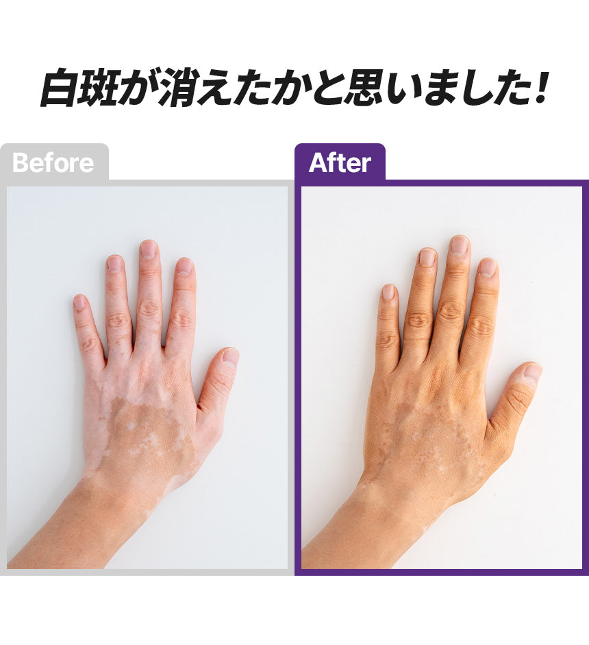 MELAFIL　ムース　カバー コンシーラー 　グローブ　セット　白斑 韓国製